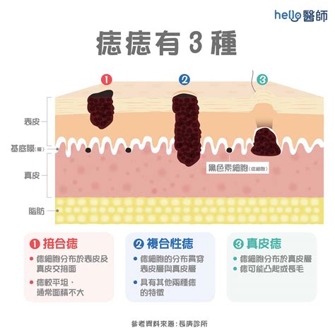 墨痣形成|墨形成：迷思與真相